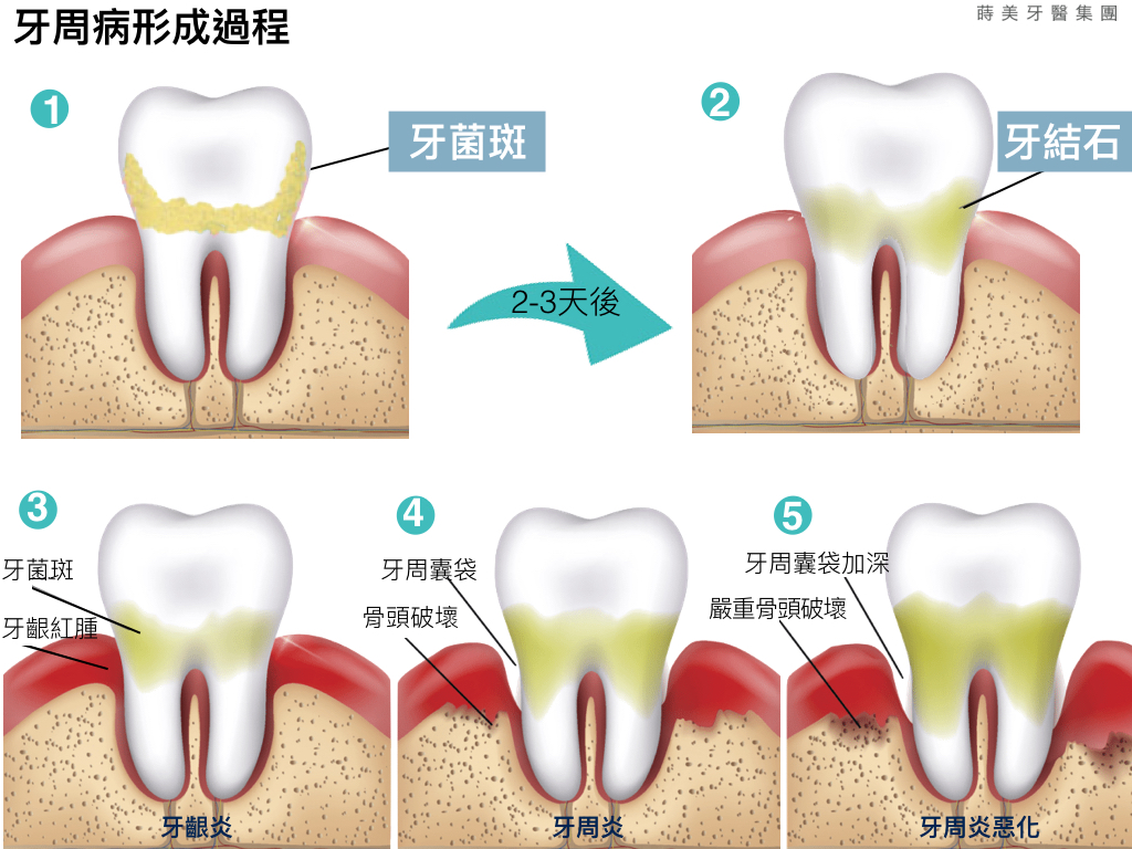 蒔美醫師專欄牙周病一定要手術嗎