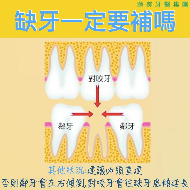 蒔美醫師專欄缺牙一定要補嗎-3-768x768