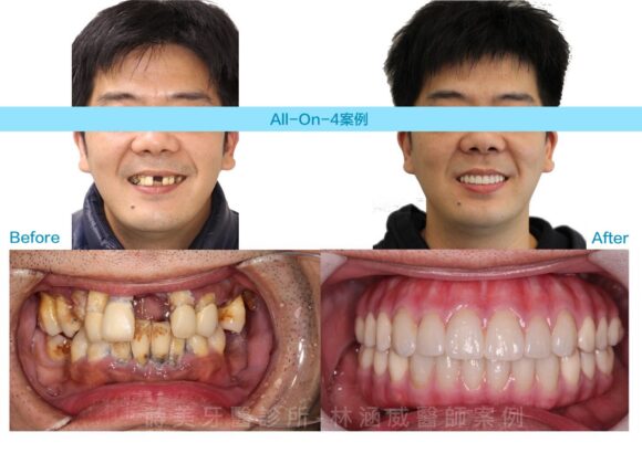 抽菸患者案例-AO4-580x410
