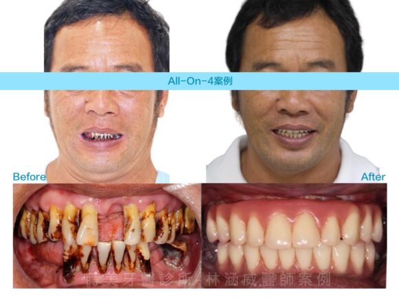 菸檳榔患者案例-AO4-580x435