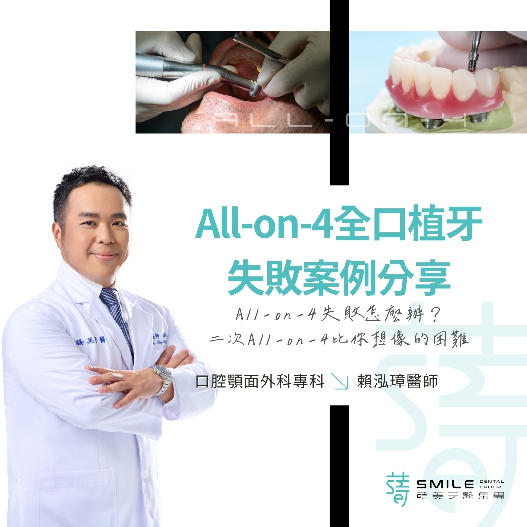 All-on-4全口植牙失敗案例分享