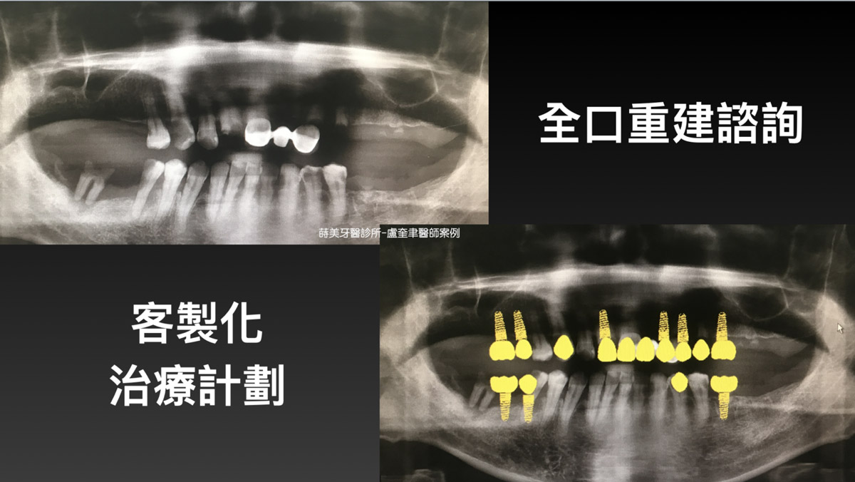 蒔美案例分享全口重建-盧奎聿醫師案例01-1536x865