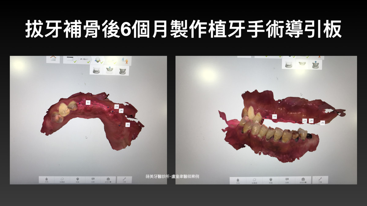 蒔美案例分享全口重建-盧奎聿醫師案例02-1536x863