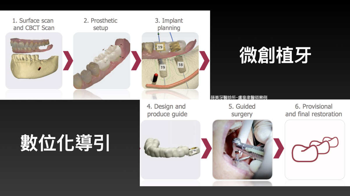 蒔美案例分享全口重建-盧奎聿醫師案例04-1536x863