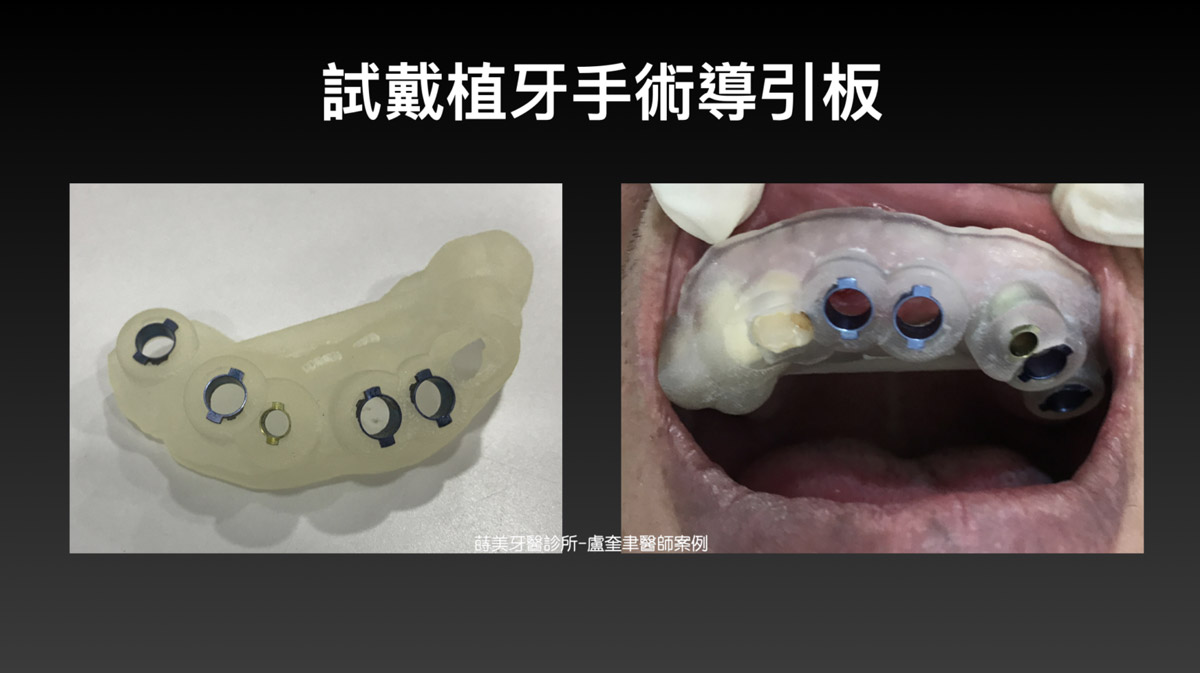 蒔美案例分享全口重建-盧奎聿醫師案例05-1536x861