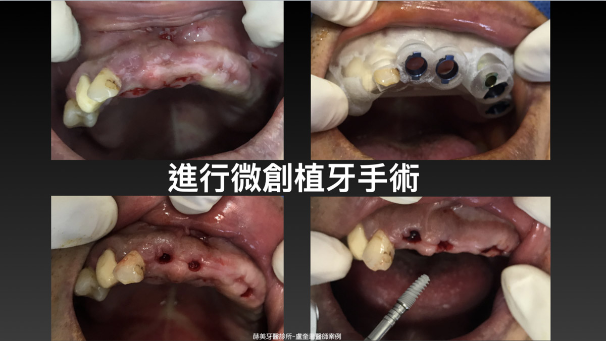 蒔美案例分享全口重建-盧奎聿醫師案例06-1536x865