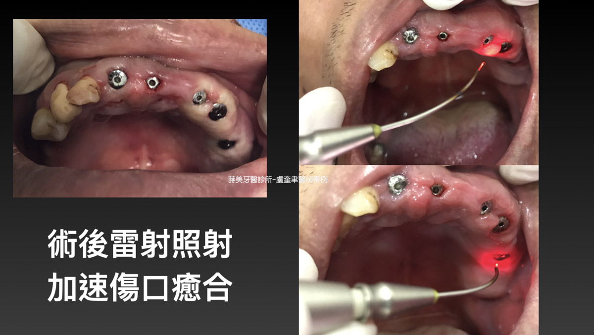蒔美案例分享全口重建-盧奎聿醫師案例07-1536x866