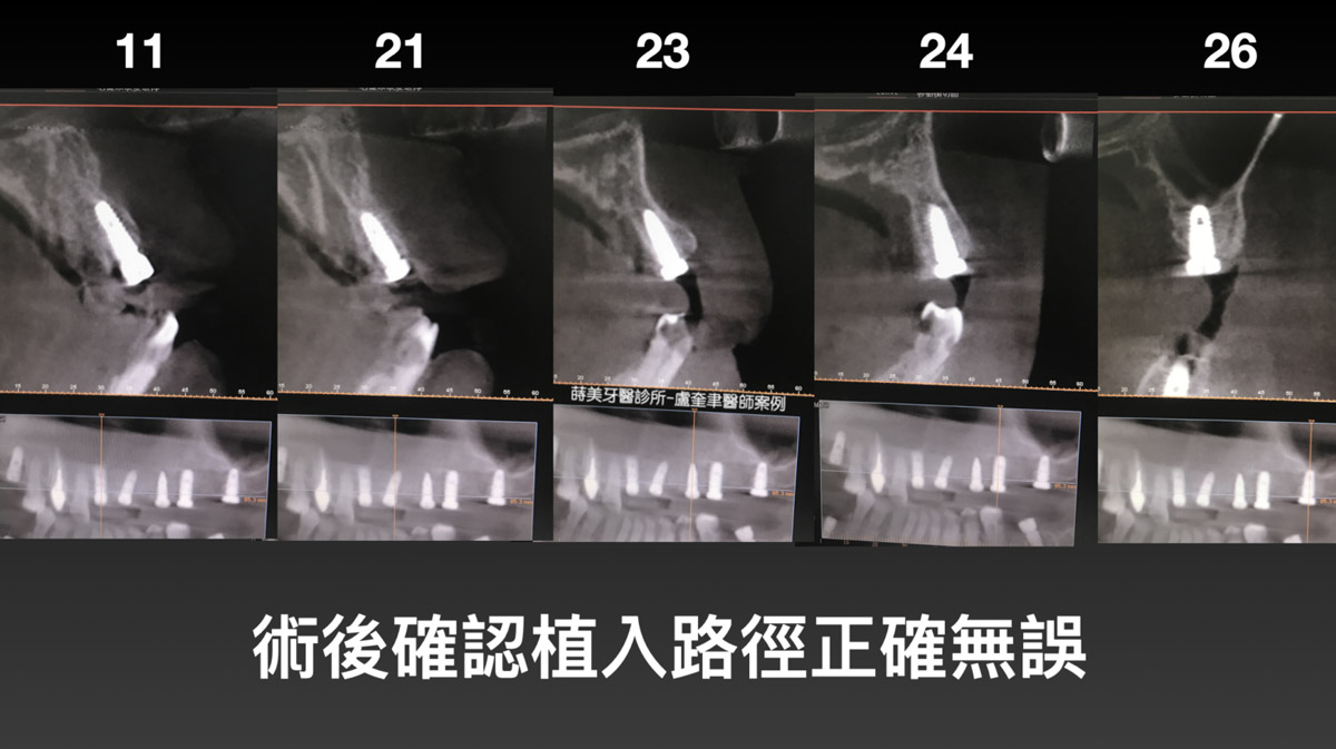 蒔美案例分享全口重建-盧奎聿醫師案例08-1536x862