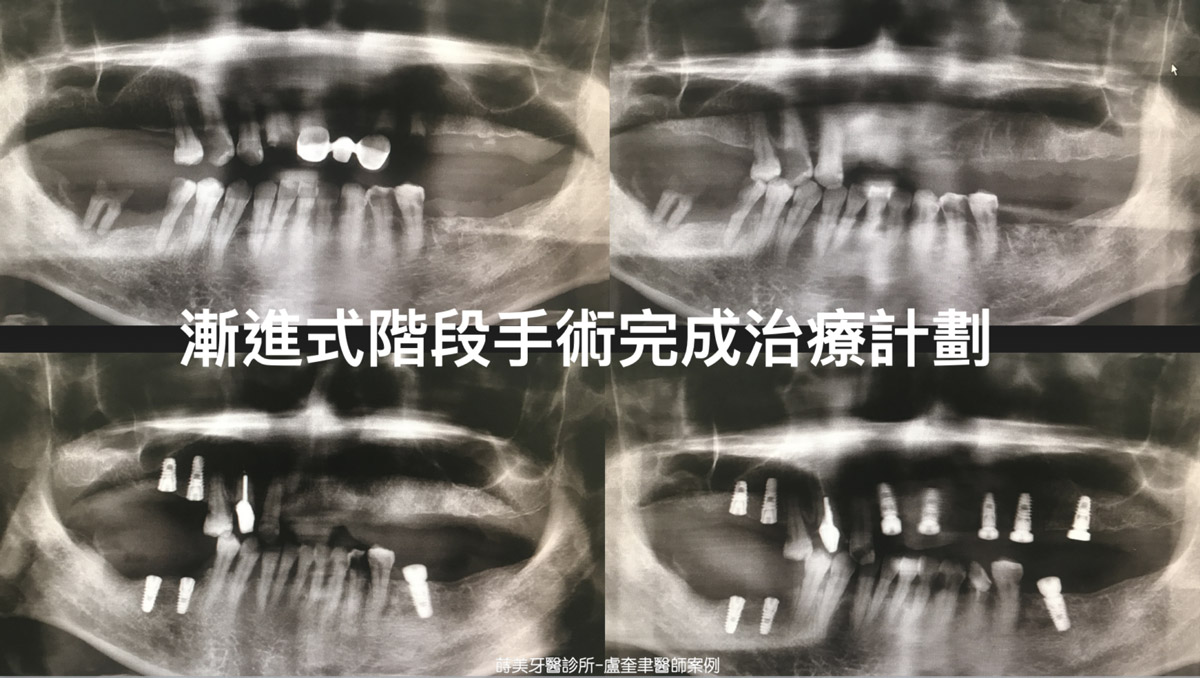 蒔美案例分享全口重建-盧奎聿醫師案例09-1536x868
