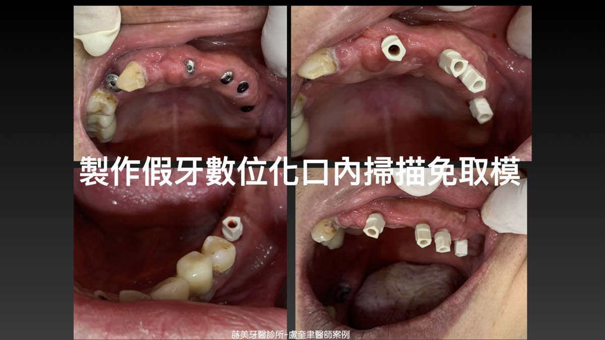 蒔美案例分享全口重建-盧奎聿醫師案例10-1536x863