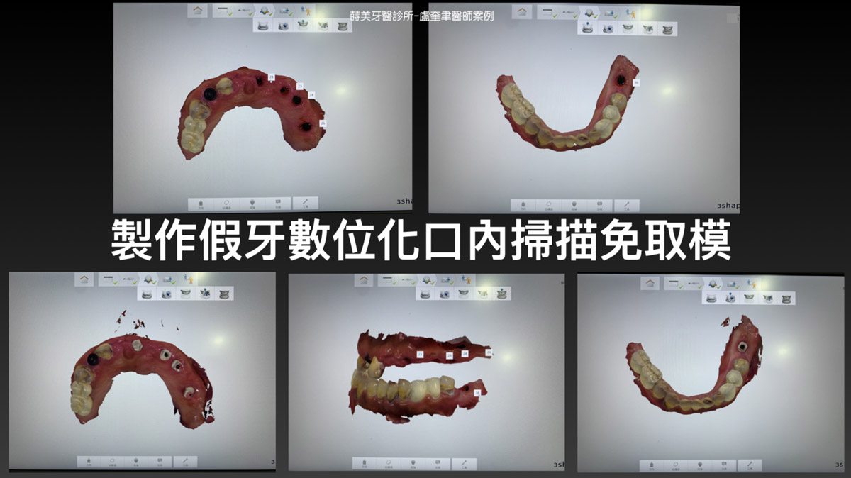 蒔美案例分享全口重建-盧奎聿醫師案例11-1536x863