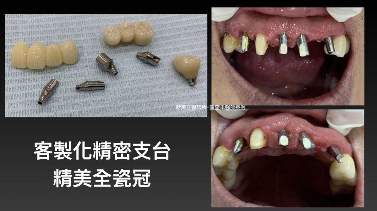 蒔美案例分享全口重建-盧奎聿醫師案例12-1536x862
