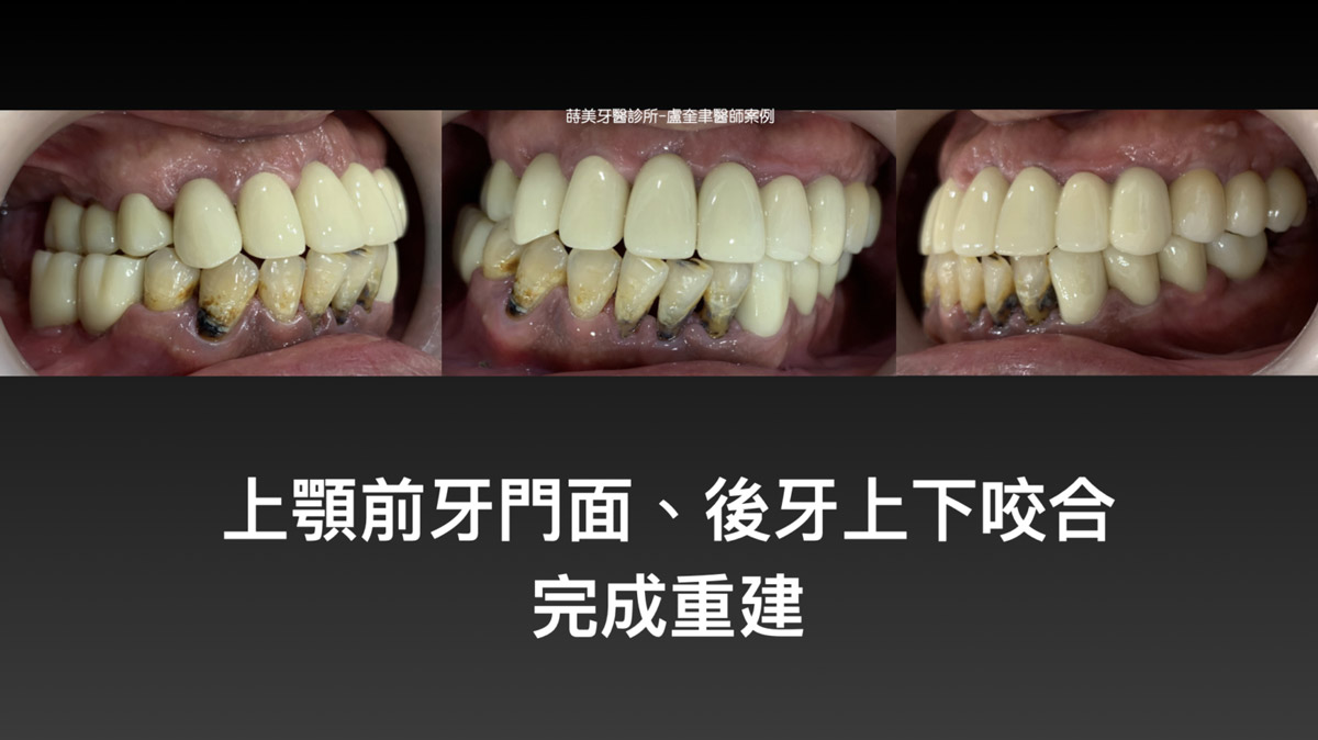 蒔美案例分享全口重建-盧奎聿醫師案例13-1536x863