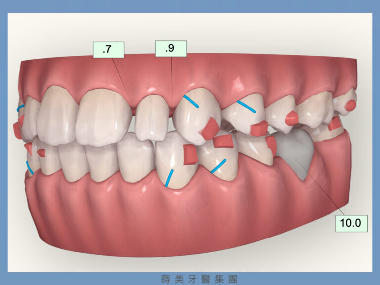 蒔美醫師專欄隱形牙套怎麼選.004-768x576