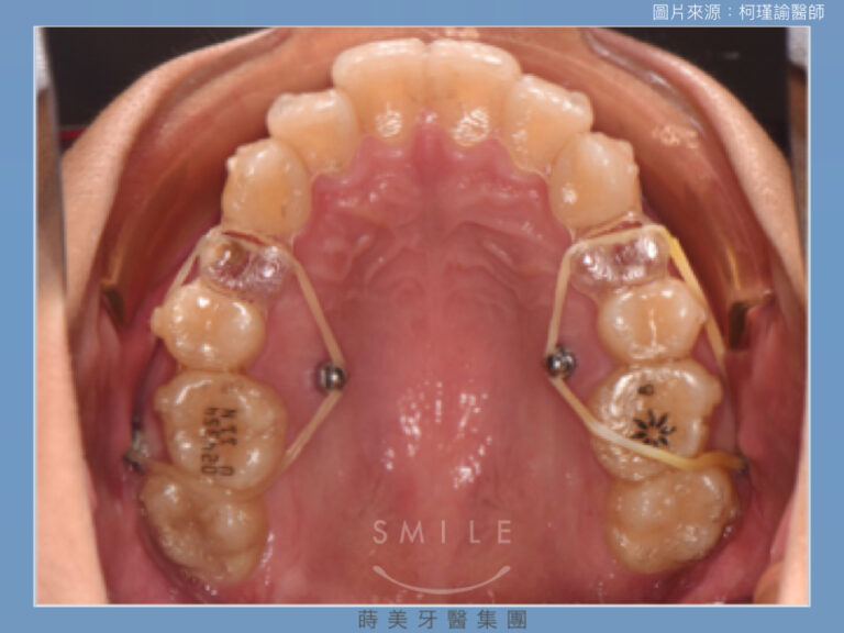 蒔美醫師專欄隱形牙套怎麼選.002-768x576