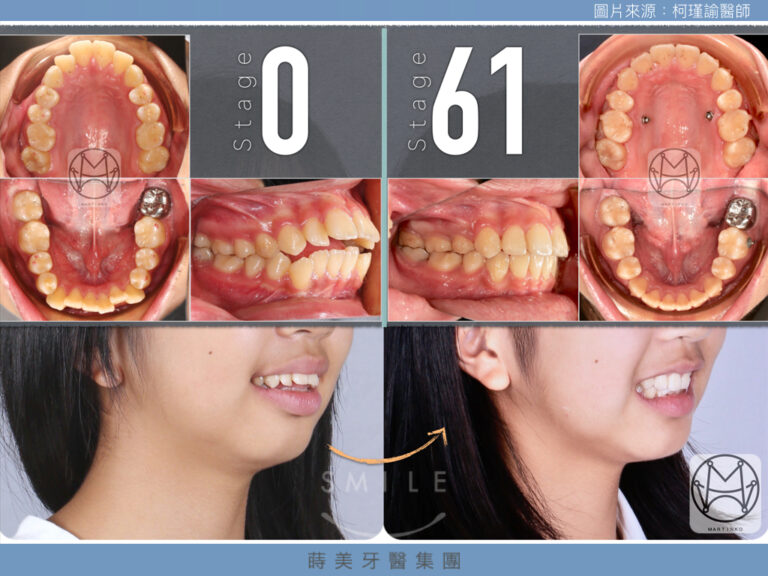 隱形牙套怎麼選.003-768x576