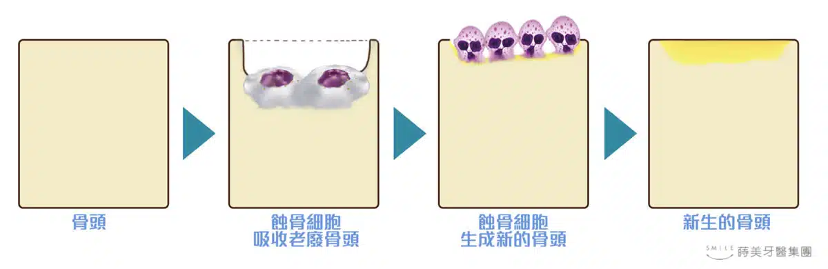 嚴格控制血糖,能減少糖尿病對植牙骨整合產生的影響