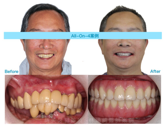 菸酒患者案例-AO4-580x464