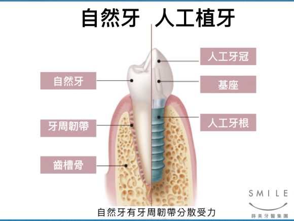 蒔美專欄-我的人工植牙裂掉了-02-580x435