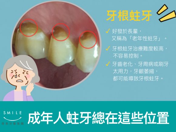 蒔美牙醫衛教成人會不會蛀牙-1-580x435
