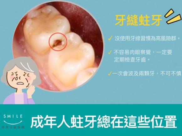 蒔美牙醫衛教成人會不會蛀牙-2-580x435