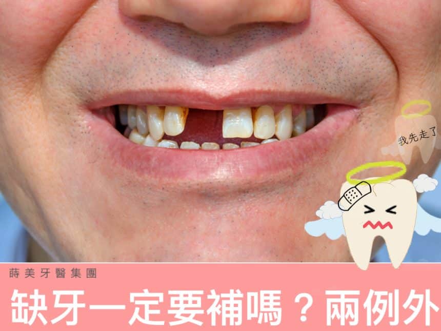 缺牙一定要補嗎?不補的5大問題與2例外!-蒔美牙醫集團