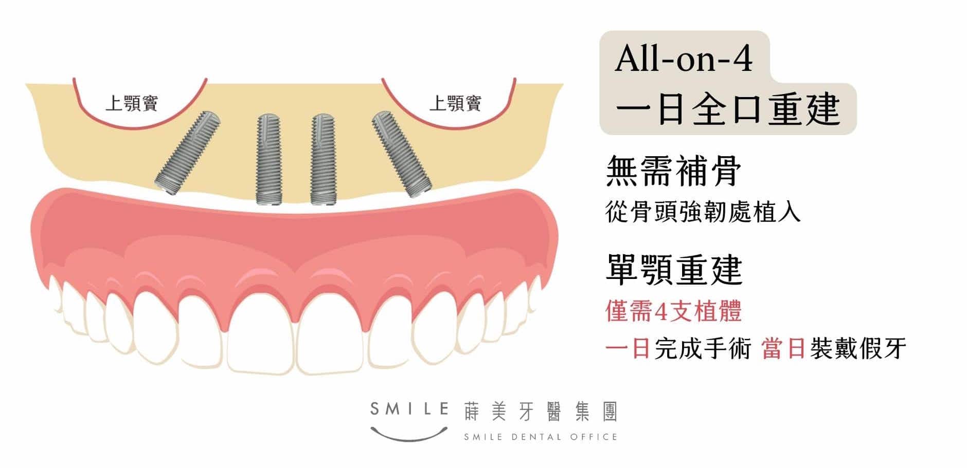 All-on-4速定式植牙無需補骨