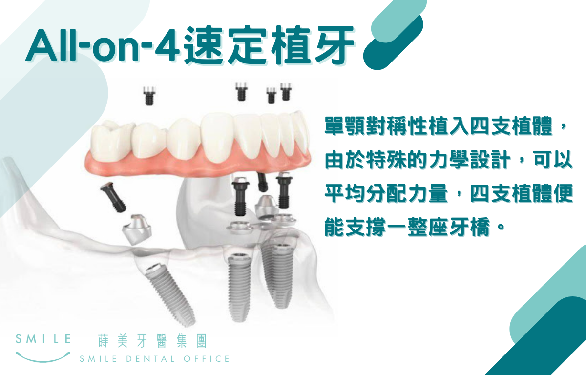 All-on-4速定植牙