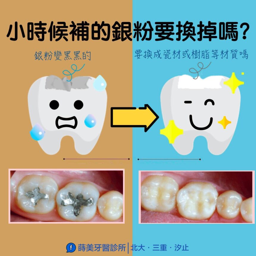 蒔美牙齒保健小時候用銀粉補的牙齒會需要換掉嗎？-860x860