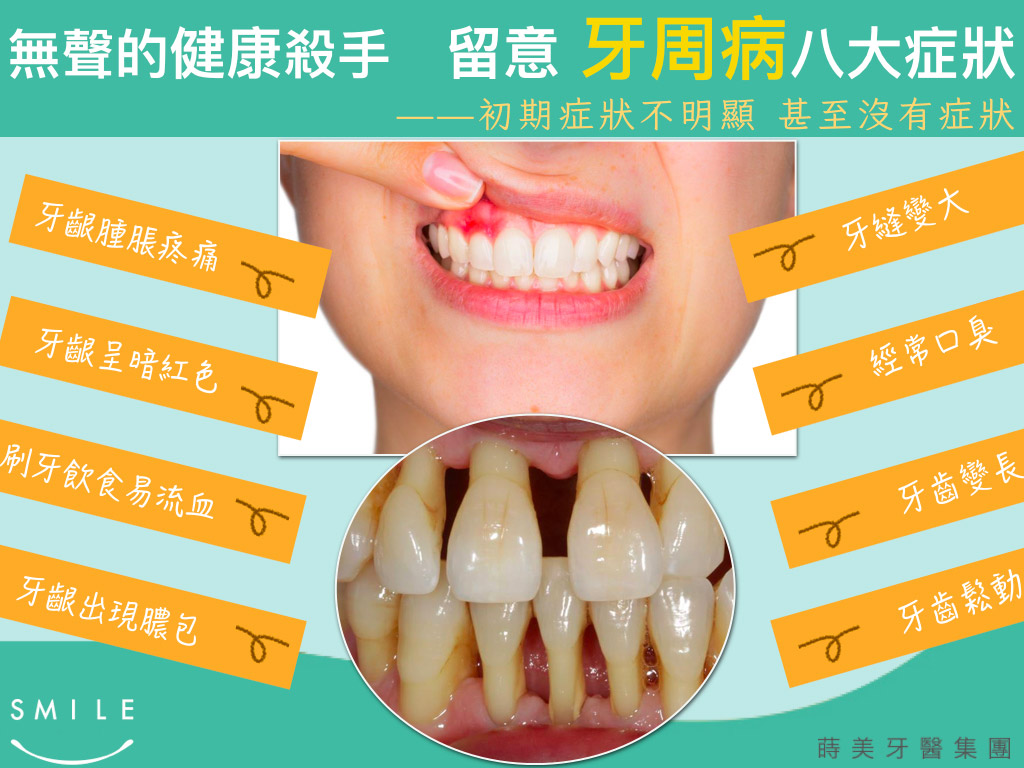 蒔美牙齒保健常識留意牙周病的八大症狀