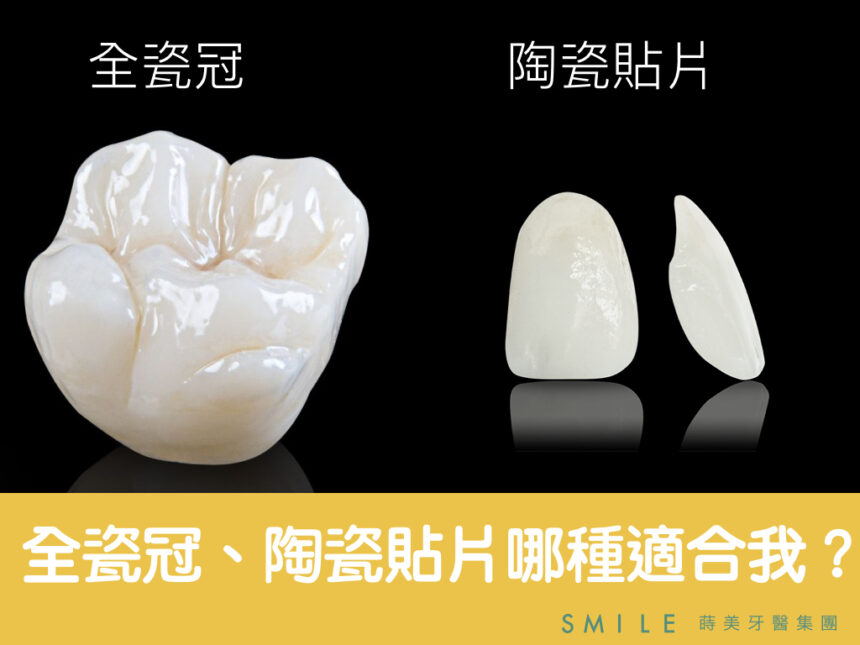 蒔美醫師專欄全瓷冠陶瓷貼片哪個適合我-860x645