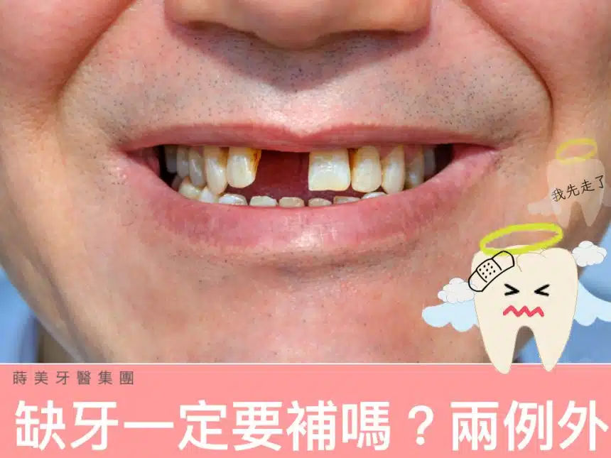 蒔美醫師專欄缺牙一定要補嗎--860x645