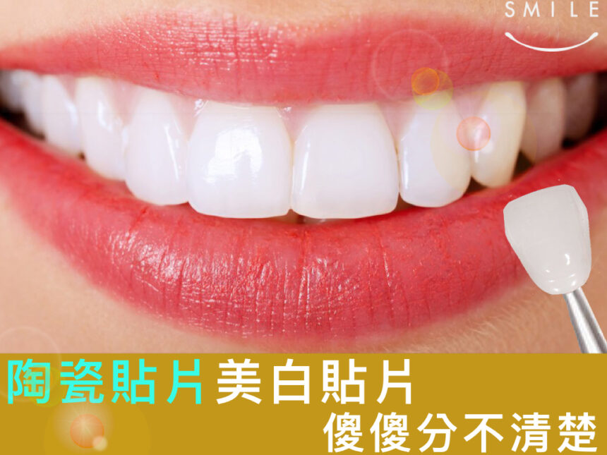 蒔美醫師專欄美白貼片、陶瓷貼片傻傻分不清楚-860x645