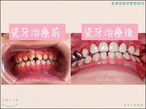 兒牙2-300x225