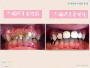 兒牙4-300x225