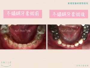 兒牙5-300x225
