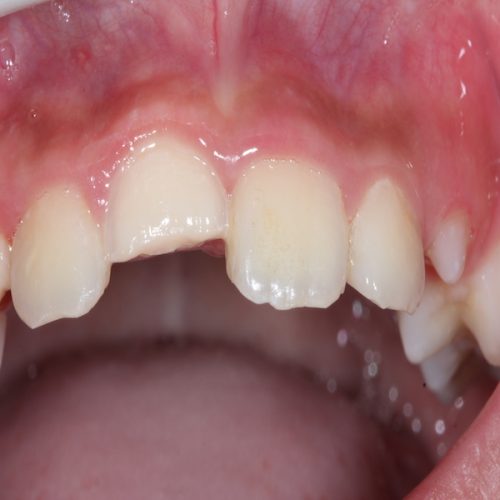 兒童前牙斷裂貼片治療-江政倫醫師-照片1-500x500