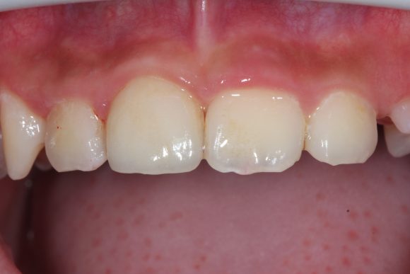兒童前牙斷裂貼片治療-江政倫醫師-照片2-1-580x387