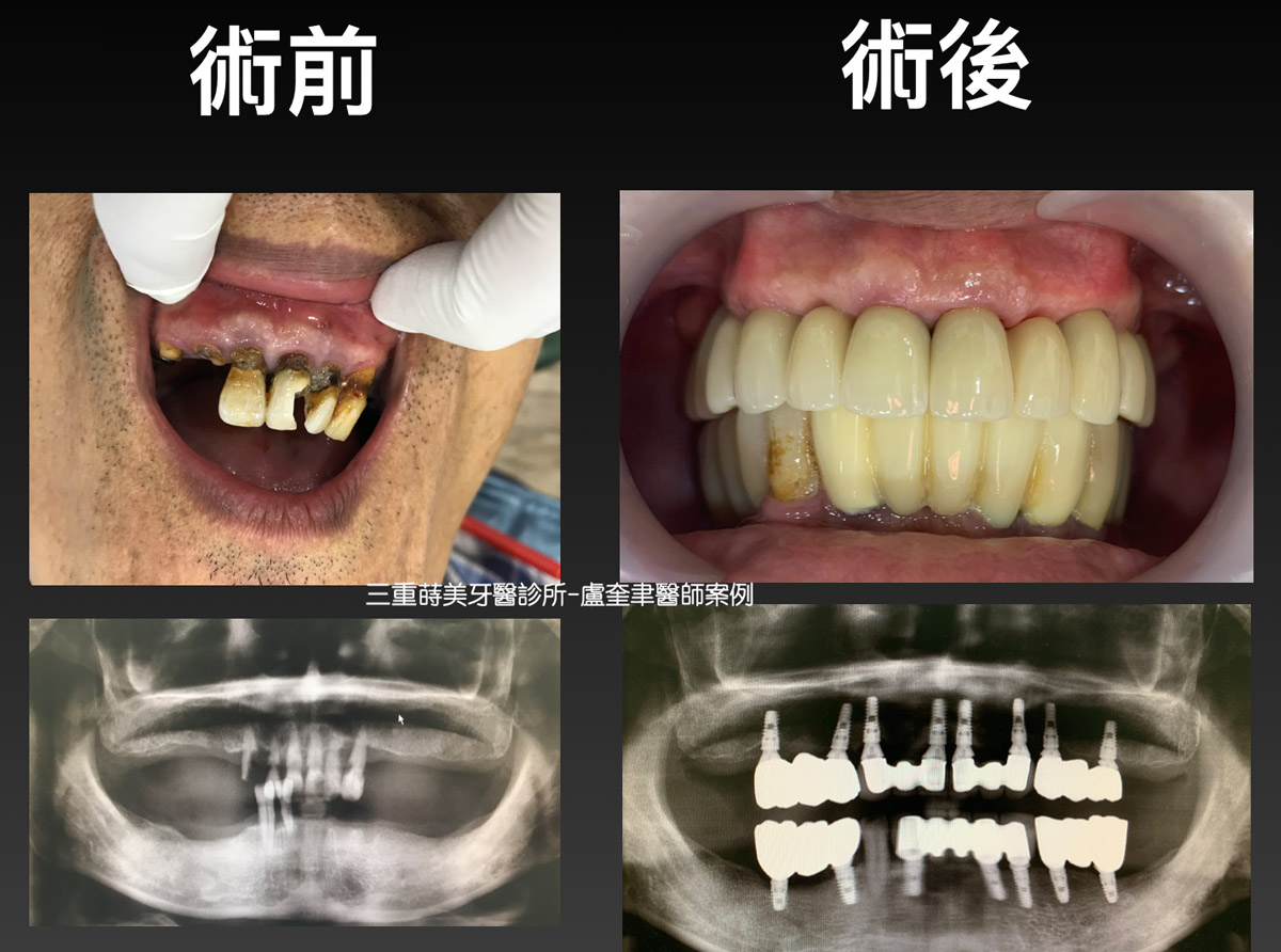 蒔美案例分享全口重建2-盧奎聿醫師1