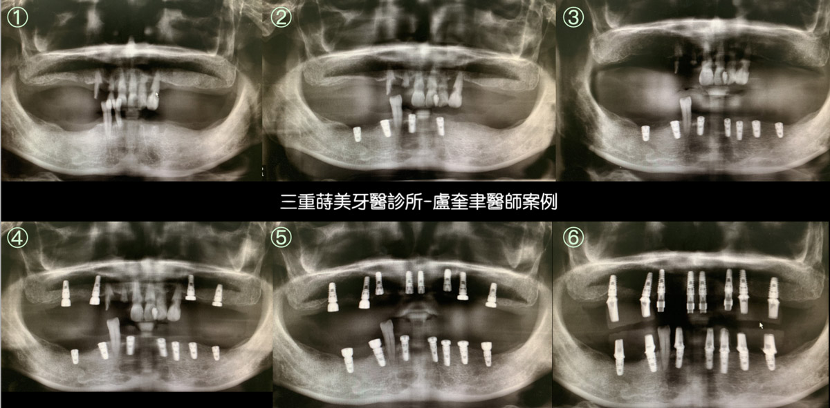 蒔美案例分享全口重建2-盧奎聿醫師2-1536x757