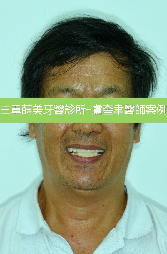 蒔美案例分享全口重建2-盧奎聿醫師3