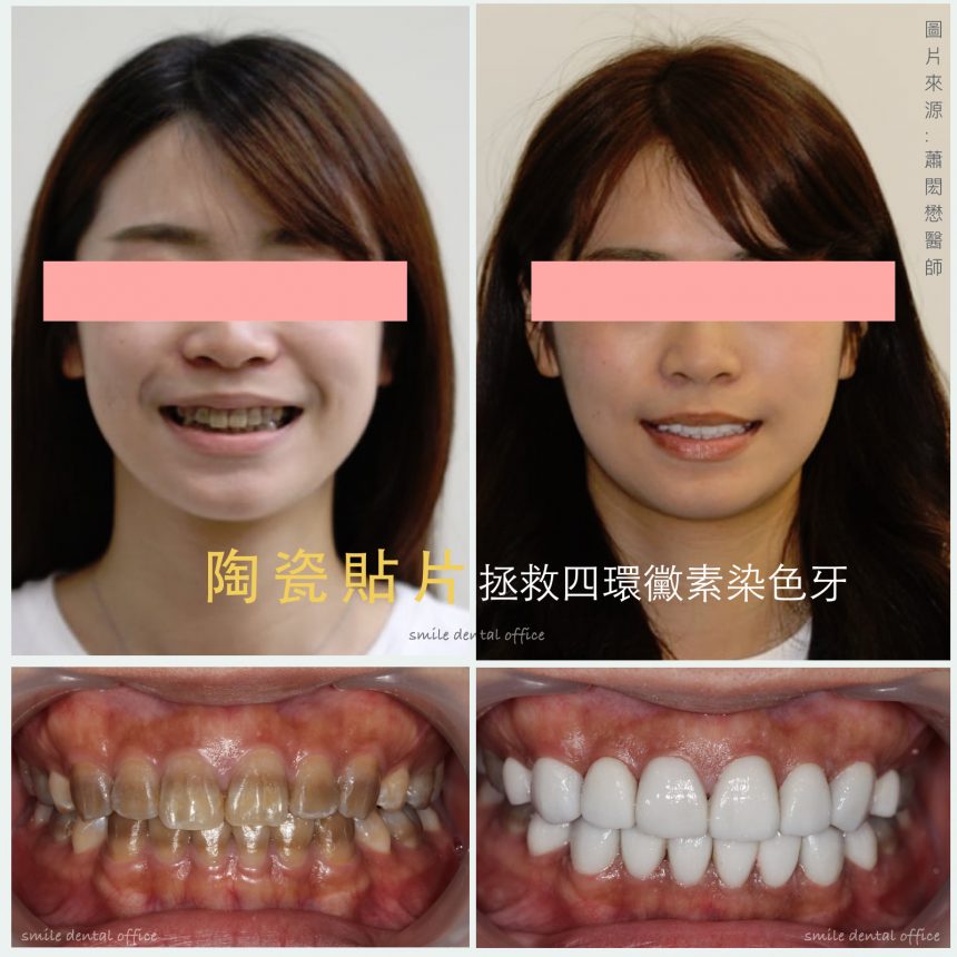 蒔美醫師案例四環黴素染色牙的重生-蕭閎懋醫師-860x860
