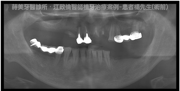 蒔美醫師案例植牙案例楊先生-B-580x293-1
