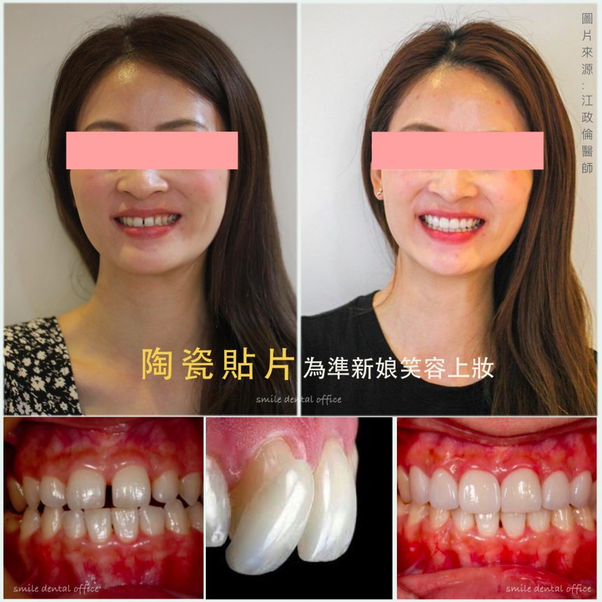 蒔美醫師案例陶瓷貼片為準新娘笑容上妝-860x860