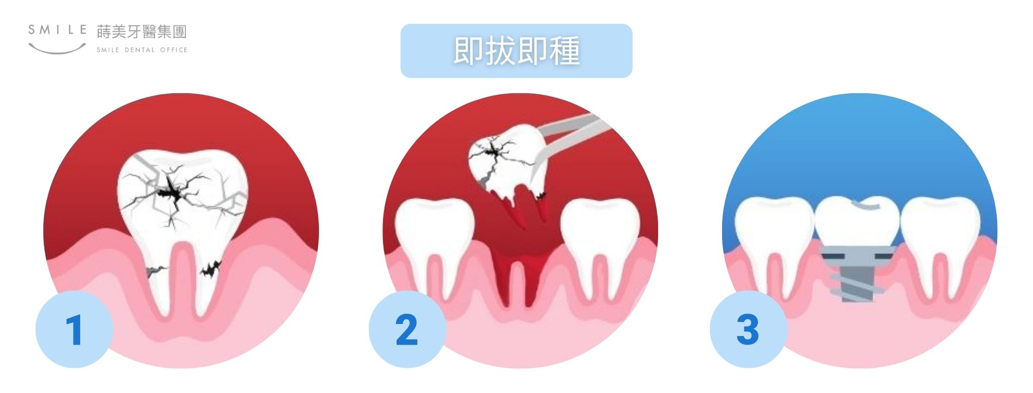 齒槽骨保存術 (8)