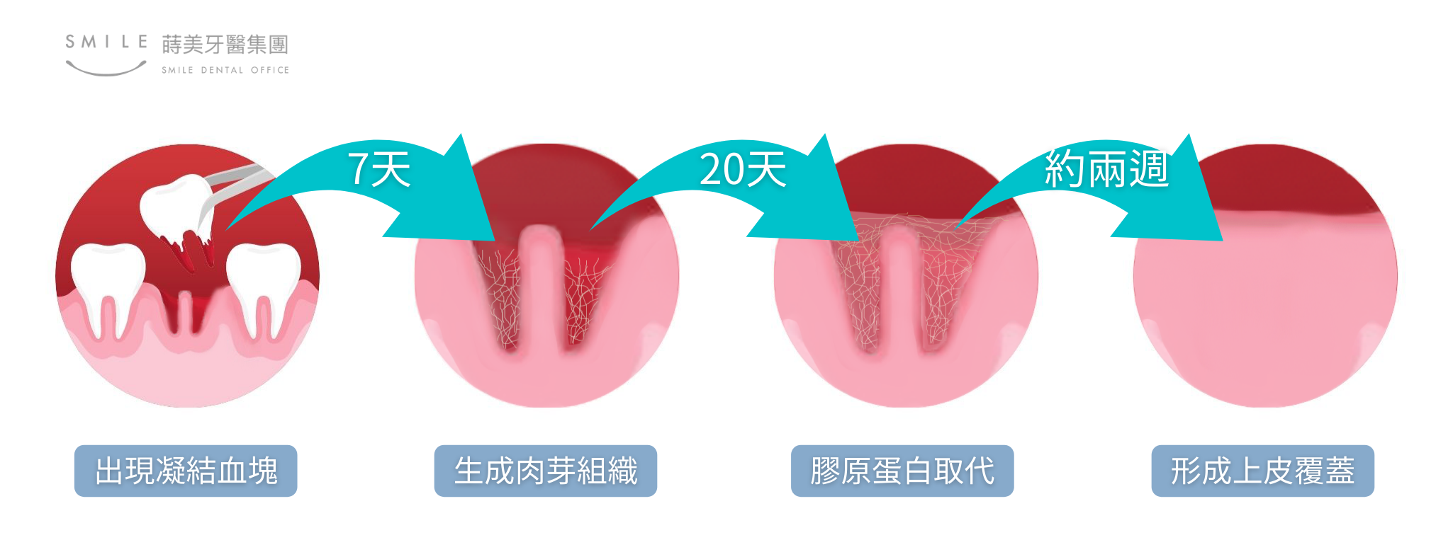 齒槽骨保存術