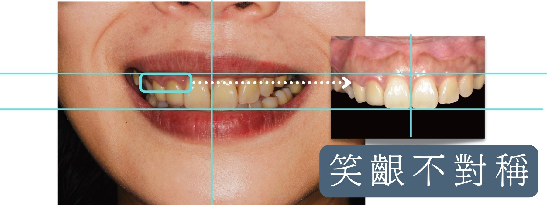 矯正案例B (14)