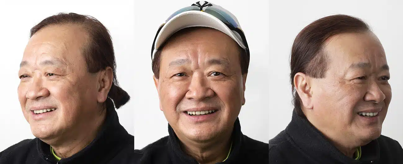 全口速定植牙案例分享