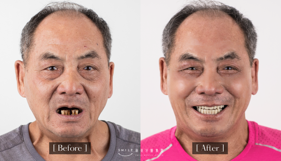 蒔美牙醫特別為全口植牙患者選用士卓曼植體降低植體周圍炎發生率