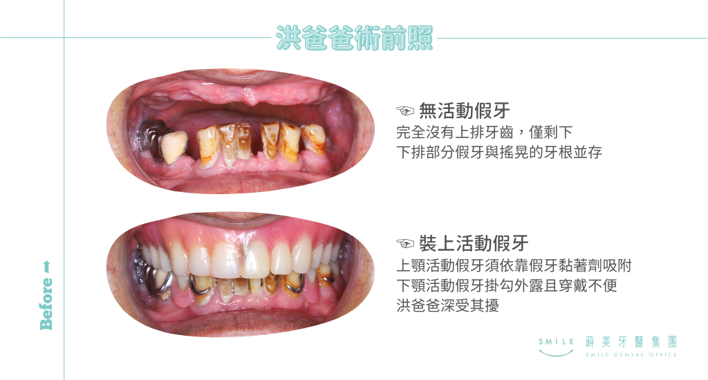 活動假牙全口缺牙